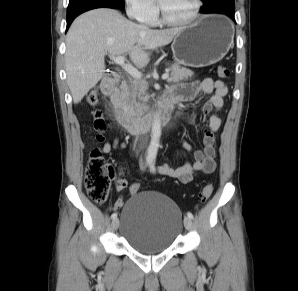 File:Acute pancreatitis (Radiopaedia 22572-22596 Coronal C+ portal venous phase 23).jpg
