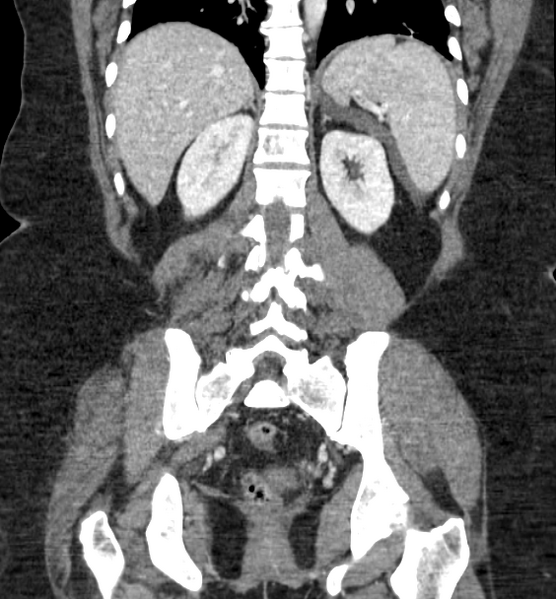 File:Acute pancreatitis - Balthazar E (Radiopaedia 29016-29377 Coronal C+ portal venous phase 66).png