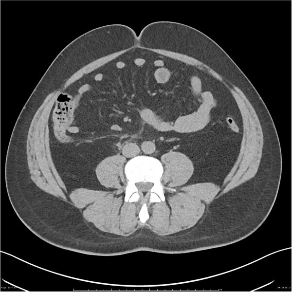 File:Acute pancreatitis - mild (Radiopaedia 27796-28033 Axial non-contrast 36).jpg