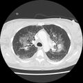 Acute pulmonary edema on CT (Radiopaedia 33582-34672 Axial lung window 17).jpg