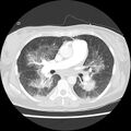 Acute pulmonary edema on CT (Radiopaedia 33582-34672 Axial lung window 25).jpg