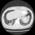 Acute pulmonary edema on CT (Radiopaedia 33582-34672 Axial lung window 45).jpg