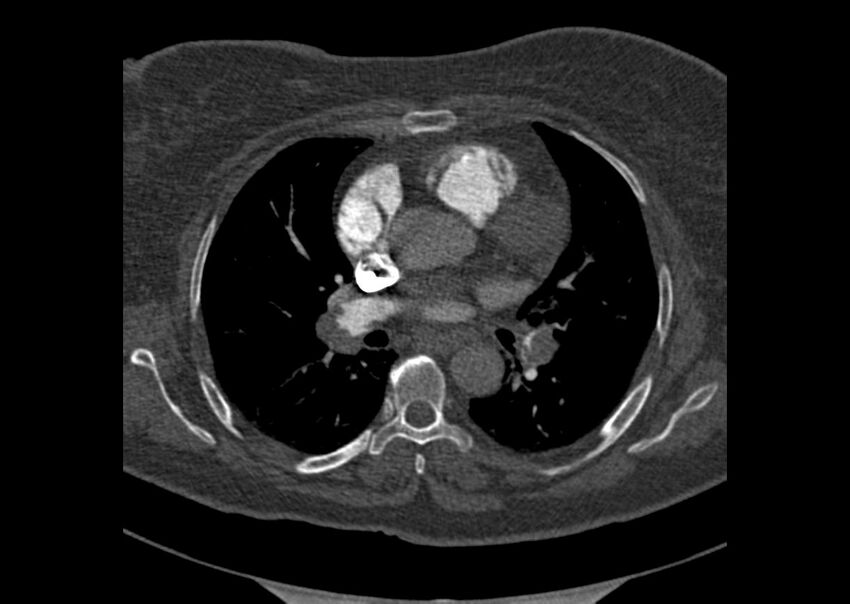 Acute pulmonary embolism (Radiopaedia 29938-30466 Axial C+ CTPA 80).jpg