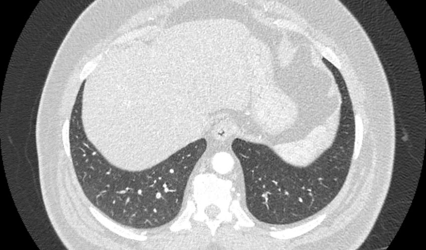 Acute pulmonary embolism with pulmonary infarcts (Radiopaedia 77688-89908 Axial lung window 109).jpg