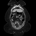 Acute pyelonephritis (Radiopaedia 25657-25837 Coronal renal parenchymal phase 21).jpg