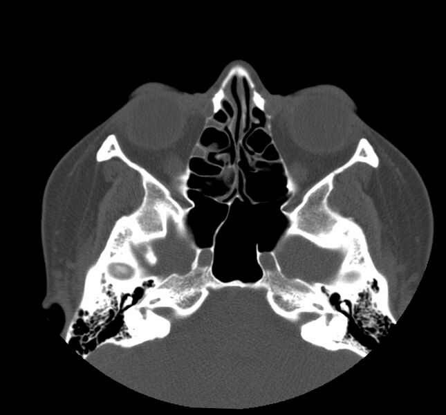 File:Acute sinusitis (Radiopaedia 22419-22455 Axial non-contrast 18).jpg