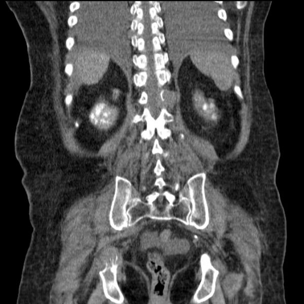 File:Acute tubular necrosis (Radiopaedia 28077-28334 G 65).jpg