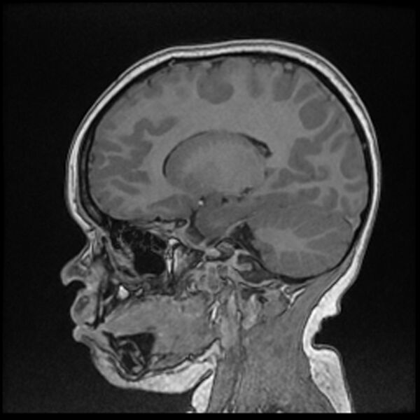 File:Adamantinomatous craniopharyngioma (Radiopaedia 77407-89529 Sagittal T1 C+ 52).jpg