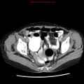 Adenocarcinoma of the colon (Radiopaedia 8191-9039 Axial liver window 66).jpg