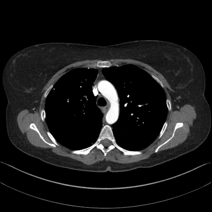 Adenocarcinoma of the lung (Radiopaedia 44205-47803 Axial C+ portal venous phase 28).jpg