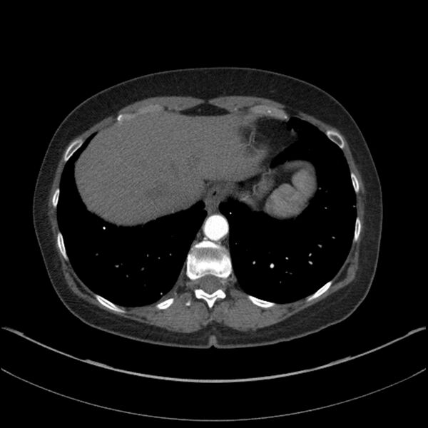 File:Adenocarcinoma of the lung (Radiopaedia 44205-47803 Axial C+ portal venous phase 70).jpg