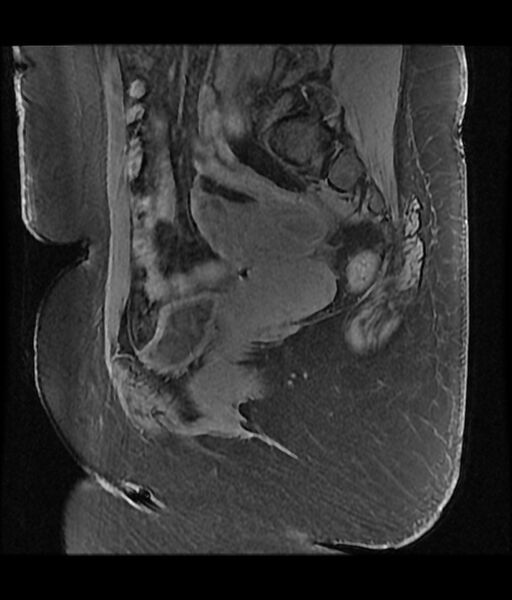 File:Adenomyosis - diffuse (Radiopaedia 65072-74065 Sagittal T1 C+ fat sat 4).jpg