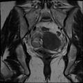Adenomyosis and endometriotic cysts (Radiopaedia 82300-96367 Coronal T2 17).jpg
