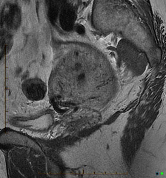 File:Adenomyosis uterus with hematometra (Radiopaedia 45779-50011 Sagittal T2 23).jpg