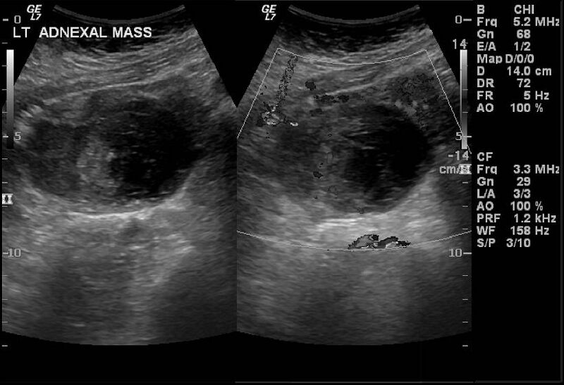 File:Adenomyosis with endometrioma (Radiopaedia 6753-7953 A 1).jpg