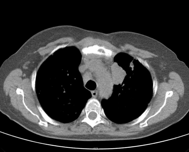 File:Adenosquamous lung carcinoma (Radiopaedia 22035-22030 non-contrast 22).jpg