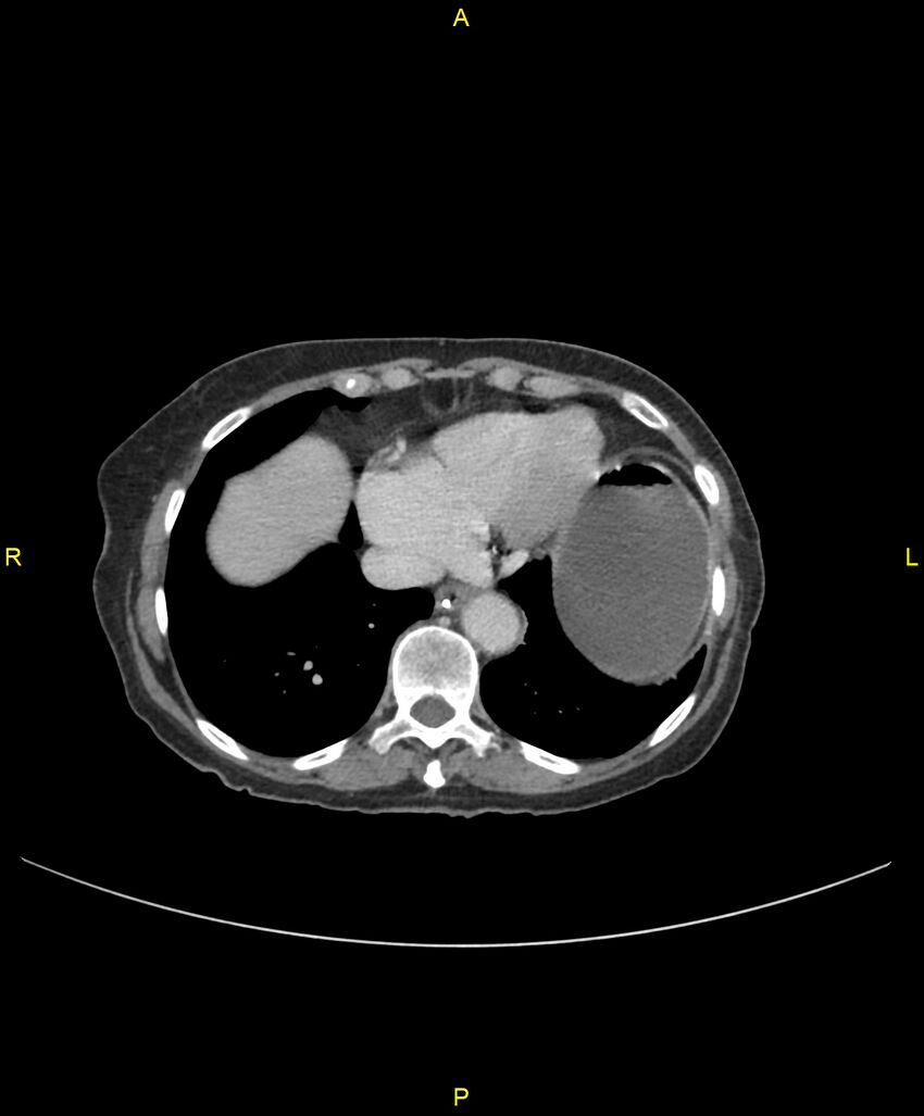 Adhesional small bowel obstruction (Radiopaedia 85402-101024 Axial C+ portal venous phase 21).jpg