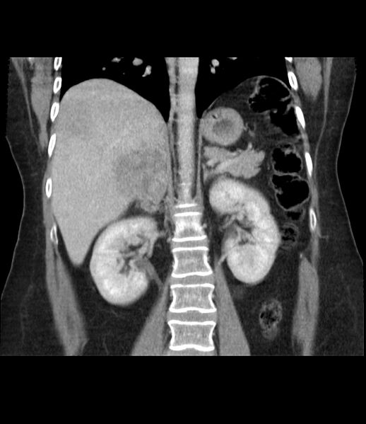 File:Adrenal cortical carcinoma with IVC invasion and thrombosis (Radiopaedia 34307-35597 Coronal C+ portal venous phase 31).jpg
