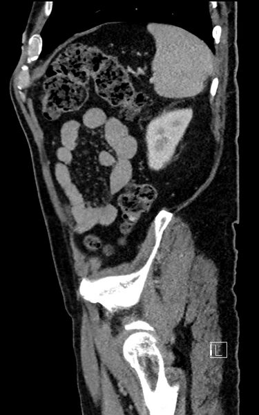 File:Adrenal lymphoma (Radiopaedia 73730-84529 Sagittal C+ portal venous phase 91).jpg