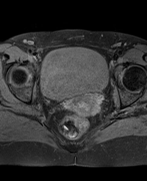 File:Adult granulosa cell tumor of the ovary (Radiopaedia 71581-81950 Axial T1 fat sat 19).jpg
