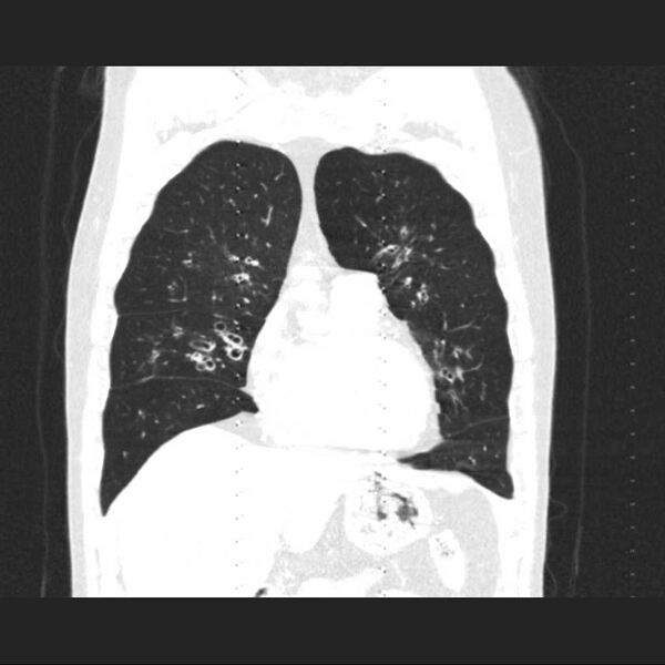File:Allergic bronchopulmonary aspergillosis (Radiopaedia 21386-21320 Coronal lung window 5).jpg