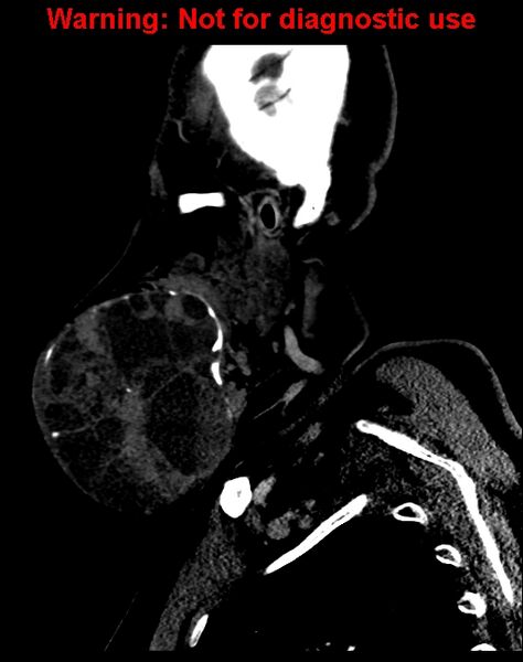 File:Ameloblastoma (Radiopaedia 33126-34164 F 14).jpg