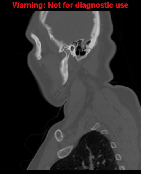 File:Ameloblastoma (Radiopaedia 33126-34164 Sagittal bone window 58).jpg