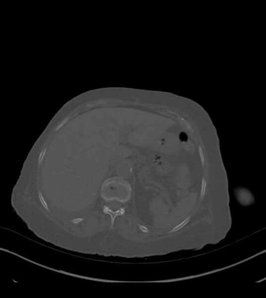 File:Amiodarone deposition in the liver (Radiopaedia 77587-89780 Axial bone window 79).jpg