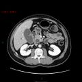 Ampullary carcinoma (Radiopaedia 56396-63056 C 40).jpg