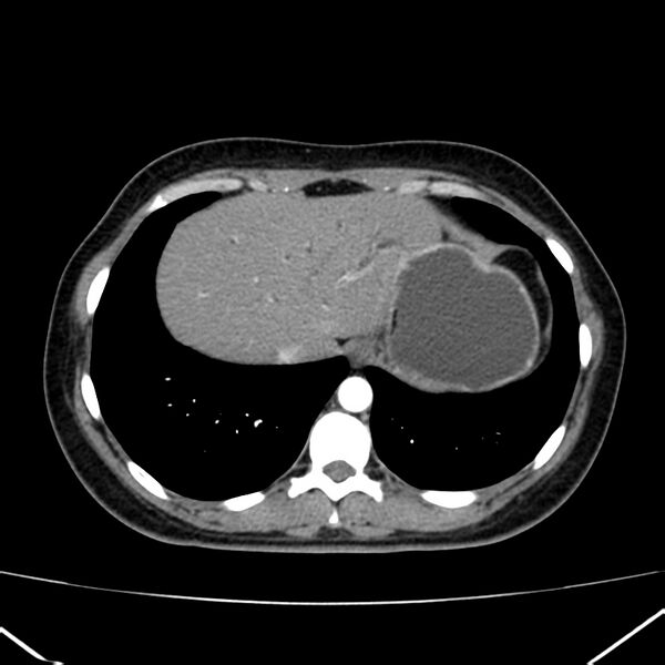 File:Ampullary tumor (Radiopaedia 22787-22816 B 10).jpg