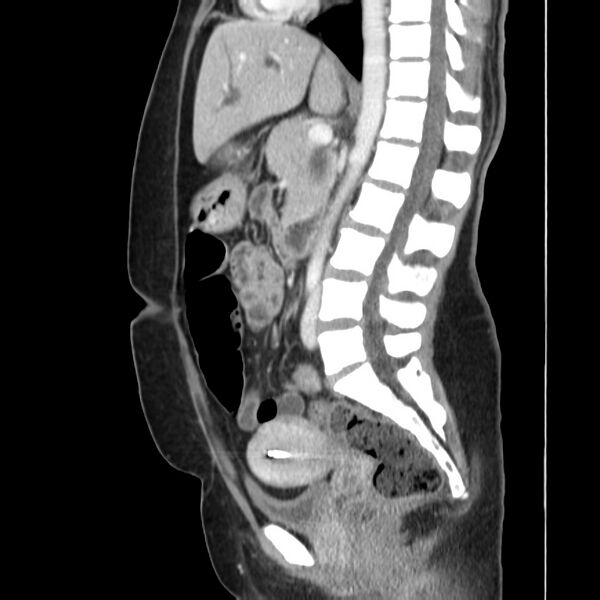 File:Ampullary tumor (Radiopaedia 22787-22816 D 29).jpg