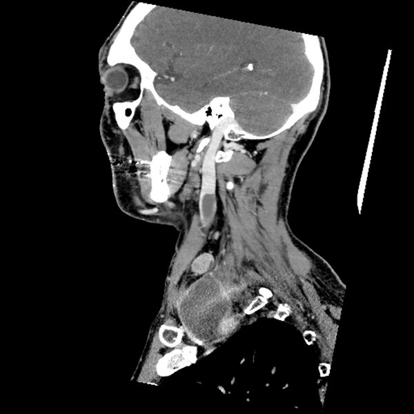 File:Anaplastic thyroid carcinoma (Radiopaedia 79087-92034 C 28).jpg