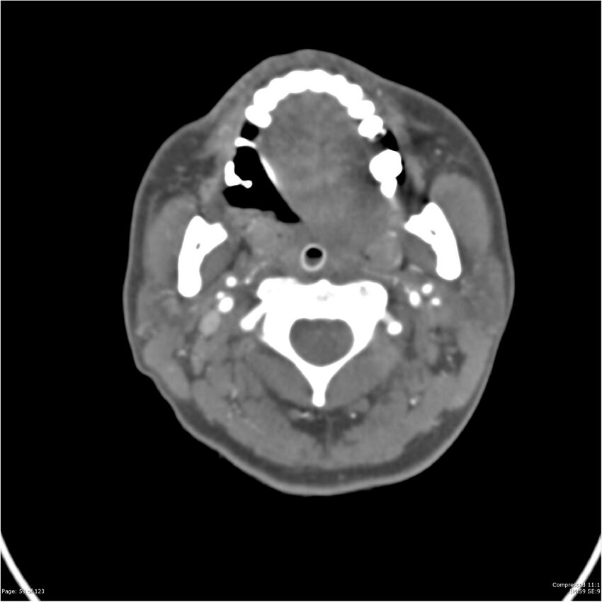 Aneurysmal subarachnoid hemorrhage and Moya Moya disease (Radiopaedia 34306-35593 Axial CT COW 59).jpg