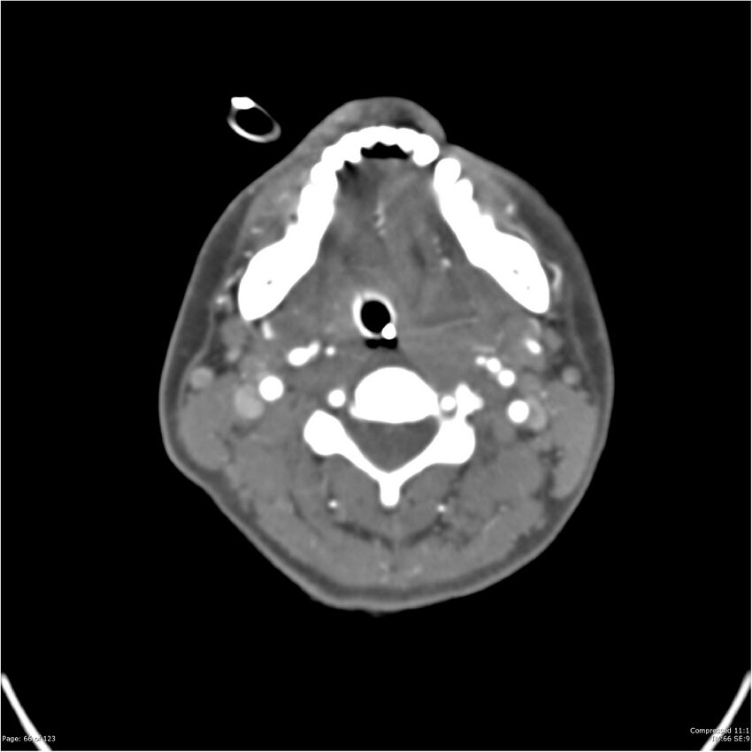 Aneurysmal subarachnoid hemorrhage and Moya Moya disease (Radiopaedia 34306-35593 Axial CT COW 66).jpg