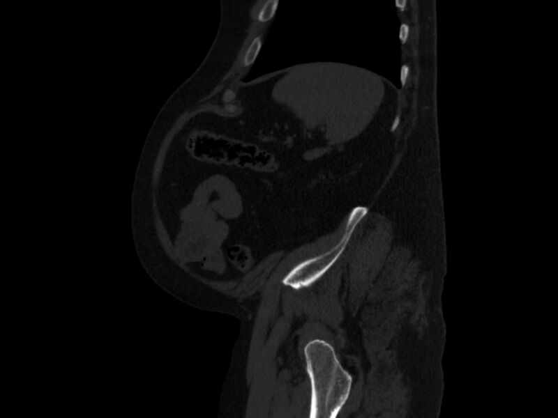 File:Ankylosing spondylitis (Radiopaedia 44609-48357 Sagittal bone window 95).jpg
