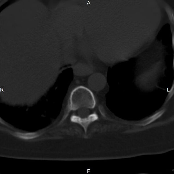 File:Ankylosing spondylitis (Radiopaedia 8748-9556 Axial bone window 3).jpg