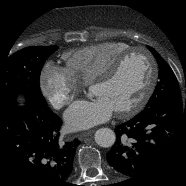 File:Anomalous origin of left circumflex artery from right coronary sinus (Radiopaedia 72563-83117 B 88).jpg