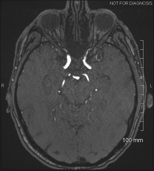 File:Anterior cerebral artery aneurysm (Radiopaedia 80683-94127 Axial MRA 92).jpg