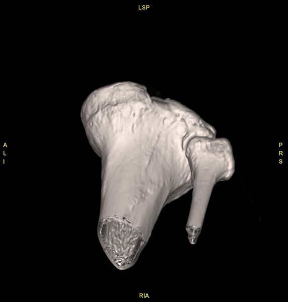 File:Anterior cruciate ligament avulsion fracture (Radiopaedia 58939-66194 VRT 14).jpg