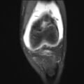 Anterior cruciate ligament tear - pediatric (Radiopaedia 62152-70260 Coronal PD fat sat 21).jpg
