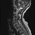 Anterior spinal artery syndrome (Radiopaedia 46335-50750 A 3).png