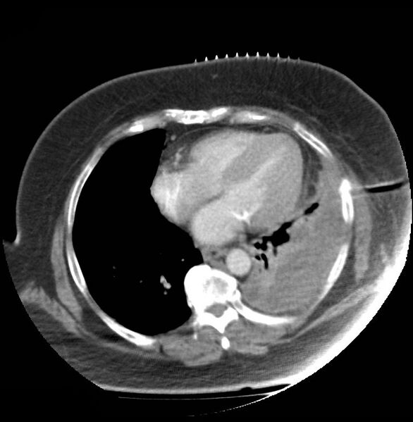 File:Aortic arch false aneurysm (Radiopaedia 14667-14588 A 16).jpg