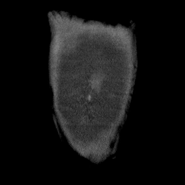 File:Aortic arch graft infection (FDG PET-CT) (Radiopaedia 71975-82437 Coronal 60).jpg