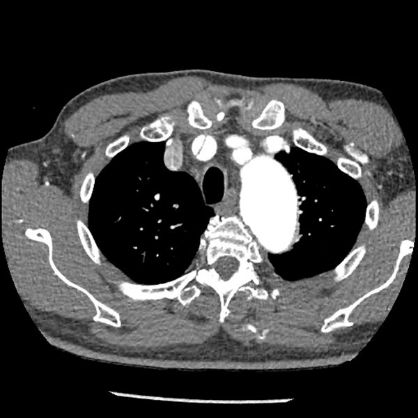 File:Aortic dissection - DeBakey Type I-Stanford A (Radiopaedia 79863-93115 A 6).jpg