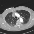 Aortic dissection - DeBakey type II (Radiopaedia 64302-73082 Axial lung window 18).png