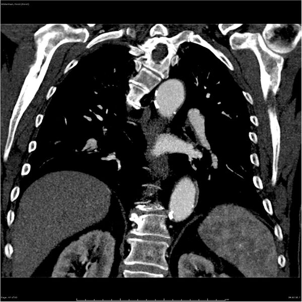 File:Aortic dissection - Stanford type A (Radiopaedia 26183-26315 A 47).jpg