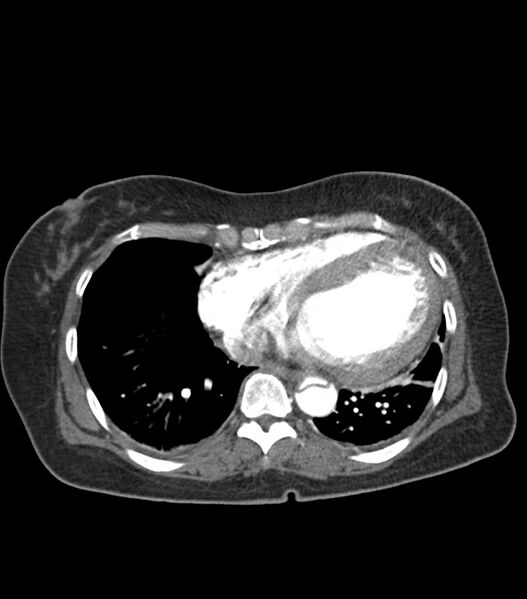 File:Aortic dissection with renal ischemia (Radiopaedia 76573-88338 A 48).jpg