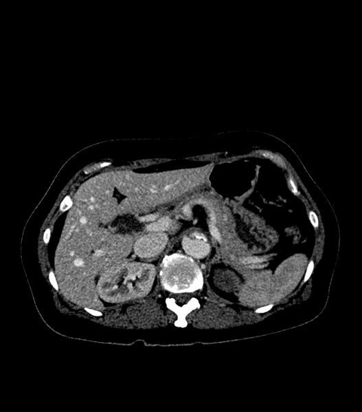 File:Aortic dissection with renal ischemia (Radiopaedia 76573-88338 B 28).jpg