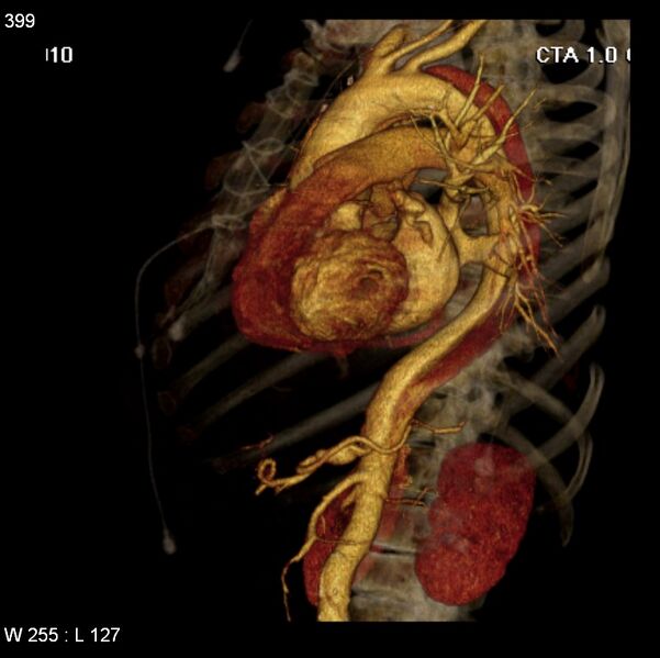File:Aortic dissection with rupture into pericardium (Radiopaedia 12384-12647 C+ arterial phase 31).jpg