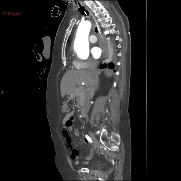 File:Aortic intramural hematoma (Radiopaedia 27746-28001 C 23).jpg